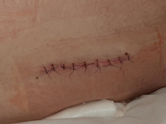 Scar outcomes not improved by closer sutures in wound closure