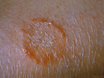 Emerging fungal skin infections reported