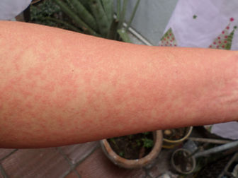 Viral conditions to consider for morbilliform eruptions in pediatric patients