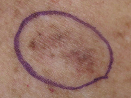 Variations in cutaneous melanoma in young patients identified