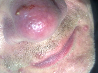 New study supports low-dose isotretinoin for resistant rosacea