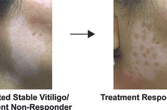 Study identifies tissue characteristics of stable vitiligo