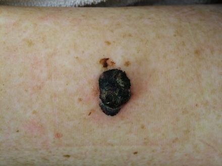 High-risk melanoma: Use of targeted therapies up, sentinel lymph node dissection down
