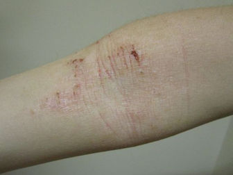 Lebrikizumab effective in patients of skin of colour with AD