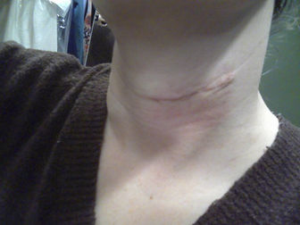 Early microneedling improves surgical scar outcomes