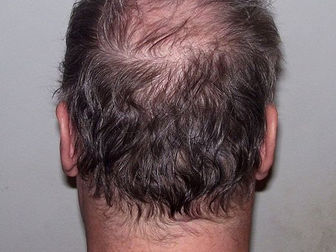 Study ranks relative efficacy of three treatments for male androgenetic alopecia