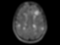 MRI-scan-of-the-brain-in-a-patient-with-multiple-sclerosisshowing-typical-lesions