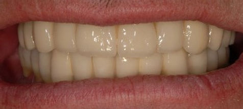 Full mouth reconstuction using implants