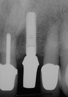 x-ray of fitted implant