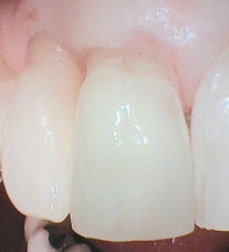 The same tooth after a bonded composite restoration