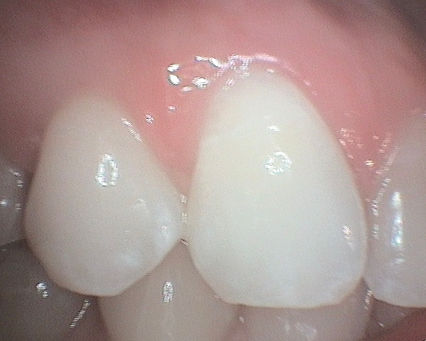 The same teeth after bleaching