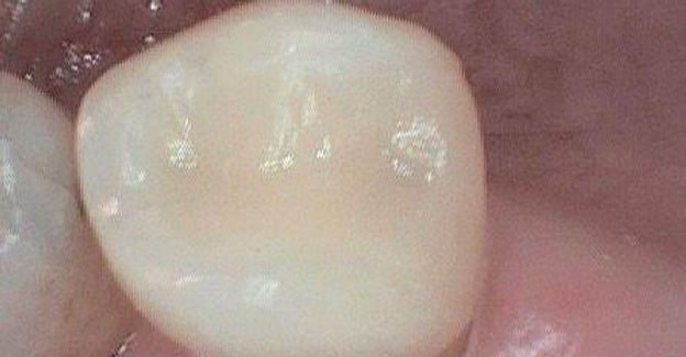 Amalgam replaced with tooth coloured fillingg