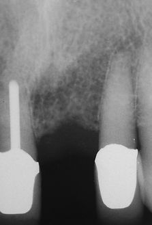 x-ray before implant