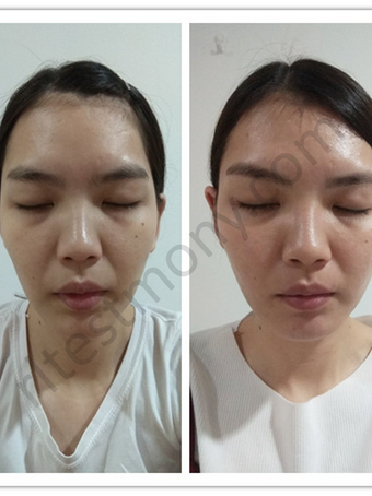 Kedutan Nasolabial dan kekenduran muka