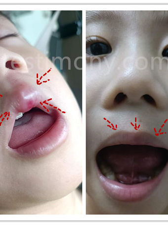 Luka Gusi Anak? H+ Penyelamat! Pembengkakan Hilang dalam 2 Jam, Penyembuhan Cepat pada Luka!