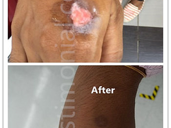 Melecur dengan minyak panas