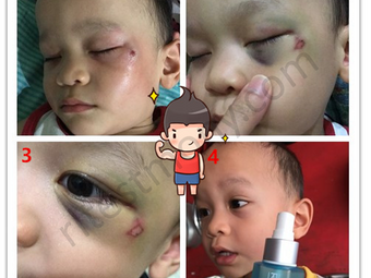 Sudut mata tercedera, merah dan bengkak