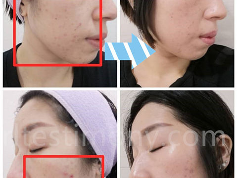 狂爆痘、狂生粉刺!!