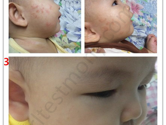 Kulit Sensitif Dan Muncul Kayap