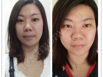 Kulit Sensitif Pada Muka Dan Muncul Jerawat, Pori Muka Tersumbat Dan Besar, Kulit Muka Suram Tidak B