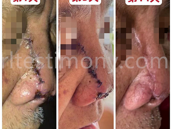 Mempercepatkan pembaikan luka selepas pembedahan