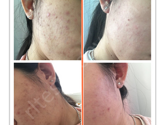 Jerawat, kulit kering dan mengelupas