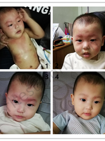 Bengkak Kemerahan Akibat Alergi