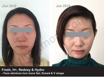 Warna Kulit Muka Menjadi Lebih Putih Berseri, Tegang Dan Bentuk V