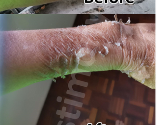 H+: Penyelamat Penyembuhan Luka