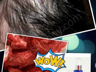 Terjatuh dan terhempas kepala, berdarah tanpa berhenti