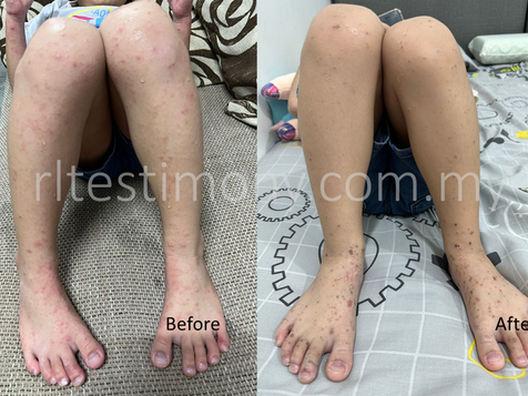 H+神奇——水痘消失的4天