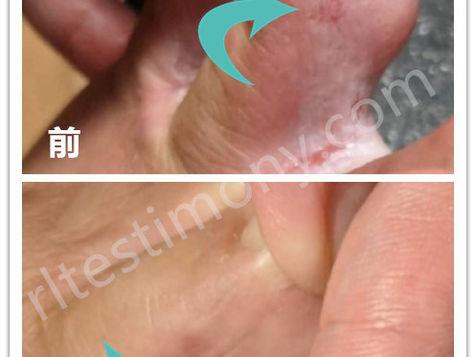 H+拯救了我多年的香港脚