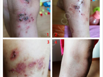 Improves skin irritation and makes scars fade