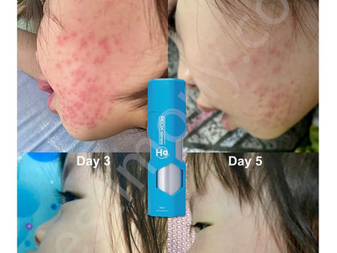 发烧,口腔溃烂,脸颊红肿