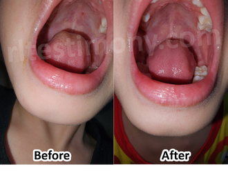 H+ Helps Child Overcome the Pain of Hand, Foot, and Mouth Disease