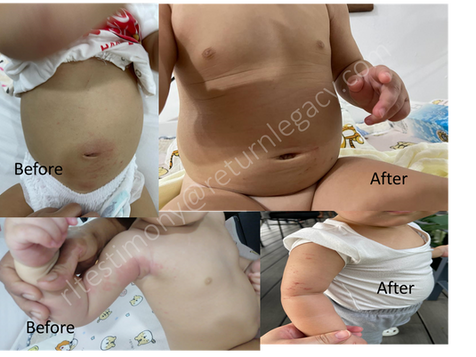 H+神奇缓解我女儿皮肤问题的故事