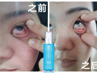 Eased eye redness caused by contact lenses