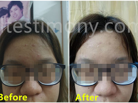 不用挤,痘痘自动会消失