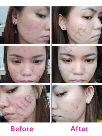 Masalah Jerawat, Merah Bengkak Dan Gatal