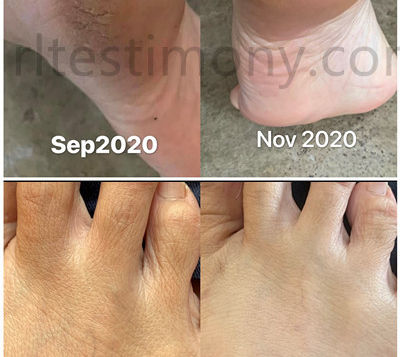 潮热,盗汗,脚跟干裂