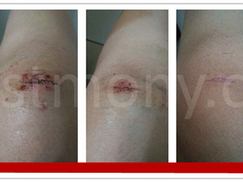 Terjatuh Di Tangga Dan Luka Pada Lutut