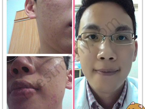 Acne prone skin, bumps and unevenness