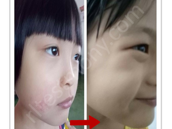 Kulit Sensitif Dan Muncul Bintik Merah