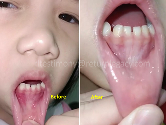 Healing for Daughter's Mouth from Hand, Foot, and Mouth Disease