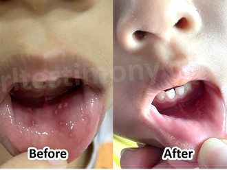 H+ is a Savior for Hand, Foot, and Mouth Disease