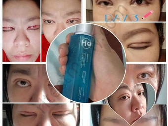 Pembedahan Kelopak Mata Ganda