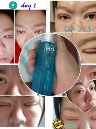 Pembedahan Kelopak Mata Ganda