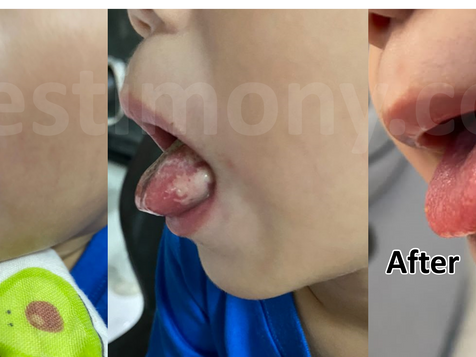 有H+在手足口症都不害怕