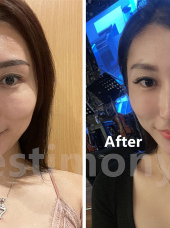 Selepas Menggunakan Redoxy selama 3 Bulan, Warna Kulit Saya dan Bintik-Bintik Gelap Saya Membaik Sec