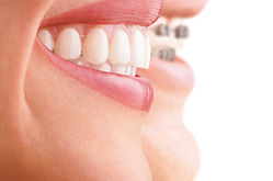INVISALIGN-EN-PROVIDENCIA-ORTODONCIA.jpg